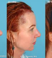 View FUE Hair Transplant for Cary Roman Photos