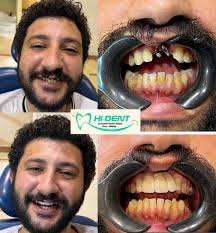 Hi Dent Dr. Ashraf Kamel (@hi.dent.egy) • Instagram photos and videos