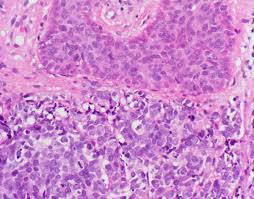 Frequent detection of merkel cell polyomavirus in human merkel cell carcinomas and identification of a unique deletion in the vp1 gene. Case Of The Week 304