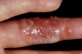 However, skin rashes can be caused by other, less dangerous factors too Herpetic Whitlow Whitlow Finger Nhs