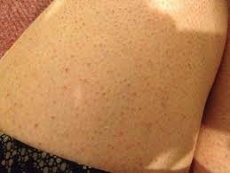 Razor Bumps Are All Too Common By Adding Key Natural Healing Agents You Can Prevent And Heal Razor Burn Learn How Skin Bumps Chicken Skin Keratosis Pilaris