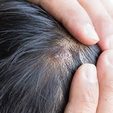 Gently comb and brush away the scale. 10 Body Parts Affected By Psoriasis