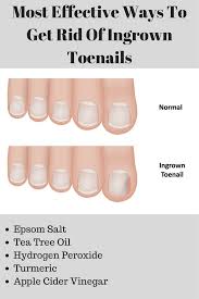 Pin On Ingrown Toenails