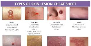 Types Of Skin Lesion Cheat Sheet Nclex Quiz
