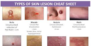 types of skin lesion cheat sheet nclex quiz