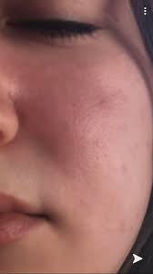 Stay tuned for more orange peel texturing tips. Skin Concern Any One Had Defected Skin Barrier And Orange Peel Texture Like This And Healed From It And What Products Did U Use Please Help Me My Skin Was Perfect And