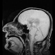 Image result for Cerebrospinal Fluid Color
