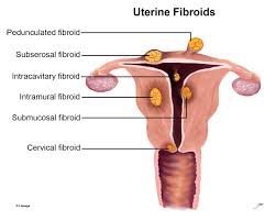 leiomyoma fibroids oncology medbullets step 2 3