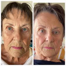 EMFACE Facial Lifting Treatments with HydraFacial in Baja, Mexico