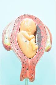 Image result for Breech Delivery