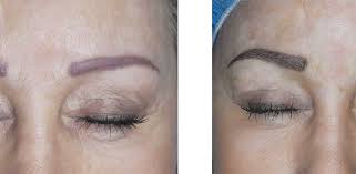 A lot of women often think that microblading and brow tattooing is the same thing because it sounds like a similar, painful process. Microblading And Hair Strokes Fading Miami Beach Microblading
