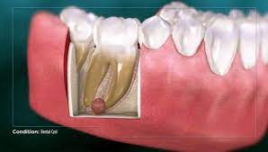 Maybe you would like to learn more about one of these? Gusi Nyeri Dan Bengkak Akibat Tambal Gigi 29 September 2020 Tanya Dokter Klikdokter Com