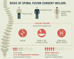 Pin On Scoliosis Neuropathy Medial