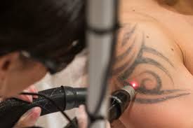 No matter the skin type, laser tattoo removal can leave a. Tattoo Removal Cost Precision Laser Toronto London