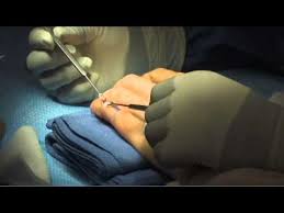 The mechanism of injury can be sudden forceful flexion of the extended fingertip or blunt trauma to the dorsum of the finger. Treatment Of Chronic Mallet Finger By Leo Rozmaryn Md Youtube