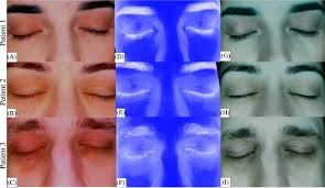 Image result for Atopic Patient