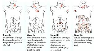 Sistem ini dikenali sebagai sistem imun. 5 Perkara Tentang Kanser Limfoma Yang Jarang Diketahui