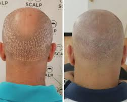 Optional installment and installation services. Pin On Hair Transplant Turkey
