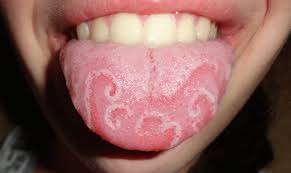 Image result for brown tongue symptoms