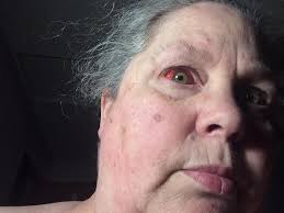 PD: Happy Halloween. A white person with no hair and is a lower left leg  amputee is sitting