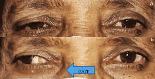 Image result for Pupillary Paralysis