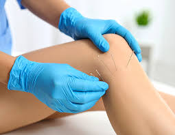What Is Dry Needling? It's a Safe Way to Relieve Pain and Improve Movement!  | Altantic Physical Therapy