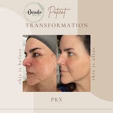 PRX Biorevitalization in Orlando, FL