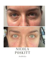 Nicola Poskitt Aesthetics Doncaster (@nicolaposkittaesthetics) • Instagram  photos and videos