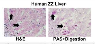 Couples with a family history of the syndrome should. Pdf Alpha 1 Antitrypsin Deficiency Liver Disease Science And Therapeutic Potential 50 Years Later A Report From An International Research Conference On Alpha 1 At Semantic Scholar