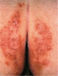 Hautpilz Beim Meerschweinchen Angesteckt