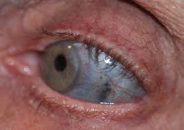 Image result for melanosis sclera