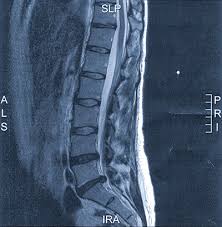 Bandscheibenvorfall Symptome Therapie Operation