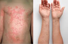 Image result for Urticaria pigmentosa children