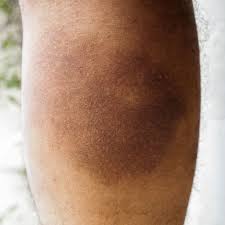 Image result for Pigment stains on the shin