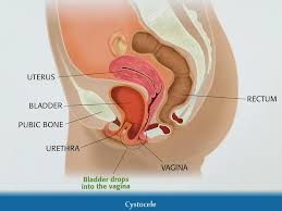 Image result for Urethral Prolapse