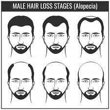 Many people experience changes to their hair at some point during their lives. Norwood Scale What Are The 7 Stages Of Hair Loss Estheticana