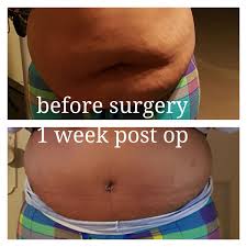 6 Week Journal Of My Tummy Tuck Tummy Tuck Cost Tummy Tucks Tummy Tuck Procedure
