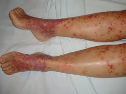 It can be due to high fever, excessive sweating, or being heat rash can occur after exposure to hot conditions. Fever And Rash Infectious Disease Advisor