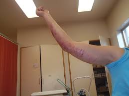 Doing so may cause some drowsiness or dry mouth, among other. Consumer Report Don T Take Benadryl Every Day Long Term Use May Be Risky For Ckd Dialysis Patients Kidneybuzz