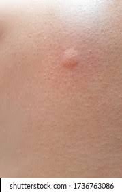 Image result for Wheal