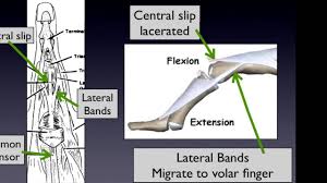 Image result for Elson Extensor Tendon Test