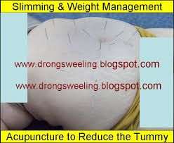 Tcm News Best Singapore Tcm Doctor For Acupuncture Obesity Slimming
