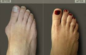 Cosmetic surgery can be performed on any part of the face and body. Cosmetic Foot Surgery Before And After Corrective Foot Surgery New York
