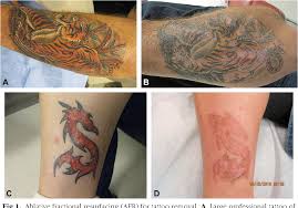 Download now 38 gambar sorotan terbaik di 2019 dekorasi instagram dan fotografi. Treatment Of Tattoo Allergy With Ablative Fractional Resurfacing A Novel Paradigm For Tattoo Removal Semantic Scholar