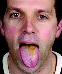 Horner S Syndrome And Ipsilateral Tongue Paresis Due To Carotid Artery Dissection Journal Of Neurology Neurosurgery Psychiatry