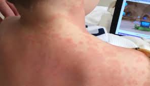 60 61 62 63 64 65 66 67 68 69 70 71 72 73 74 75 76 77 78 79 80 81 82 83 84 85 86 87 88 89 90 91 92 93 94 95 96 97 98 99 100 101 102 103 104 105 106 107 108 109 110 111 112 113 114 115 116 117 118 119 120 121 122. Health Officials Children Being Affected By Kawasaki Like Disease Linked To Covid 19