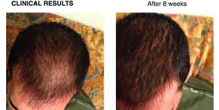 Rogaine is a topical solution that is applied by directly rubbing it onto the scalp where hair growth is desired. Hair Loss Solution Mesoestetic Http Www Hairlossmenwomen Com Hair Loss Solution Mesoestetic Hair Loss Solutions Hair Loss Loss