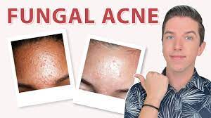 When the aging strikes, the first or probably the most prominent sign is the slackening of skin, which mostly all women at the age of 40 or above come across. Little Bumps On Your Face How To Get Rid Of Them Youtube