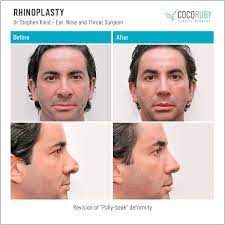 I heard rhinoplasty is covered by my insurance. Will Medicare Cover My Rhinoplasty Or Nose Surgery