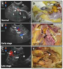 In rare cases, a suspected ovarian cancer may be. Plos One Immune Cells In The Normal Ovary And Spontaneous Ovarian Tumors In The Laying Hen Gallus Domesticus Model Of Human Ovarian Cancer